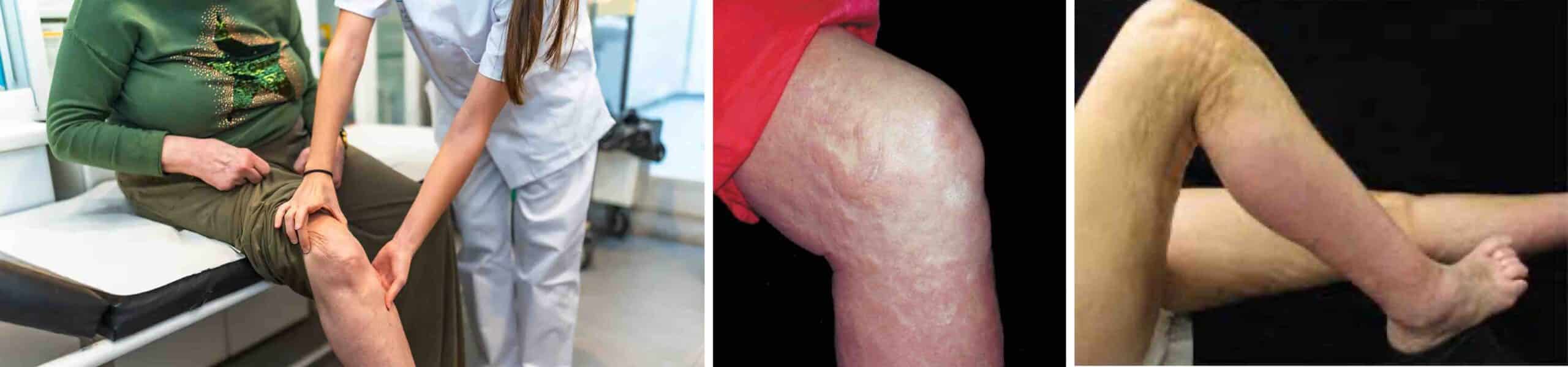 JOELHO COM ESCLERODERMIA