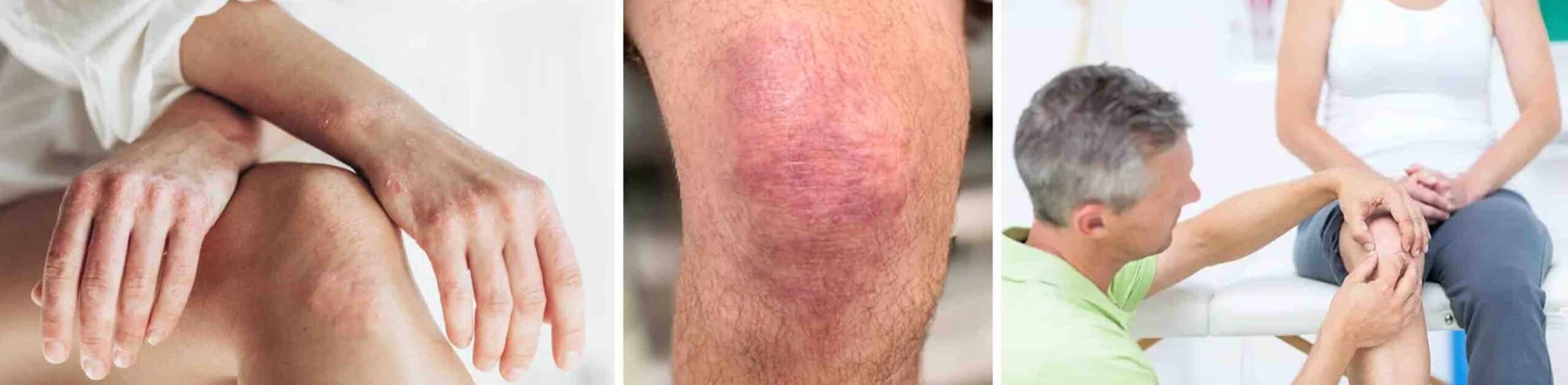 DERMATOMIOSITE NOS JOELHOS DERMATOMIOSITE NOS JOELHOS