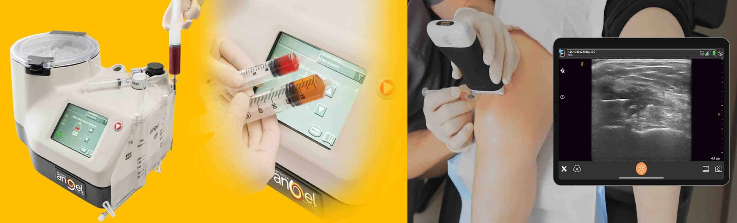 APLICAÇÃO DE PRP NO JOELHO APLICAÇÃO DE PRP NO JOELHO