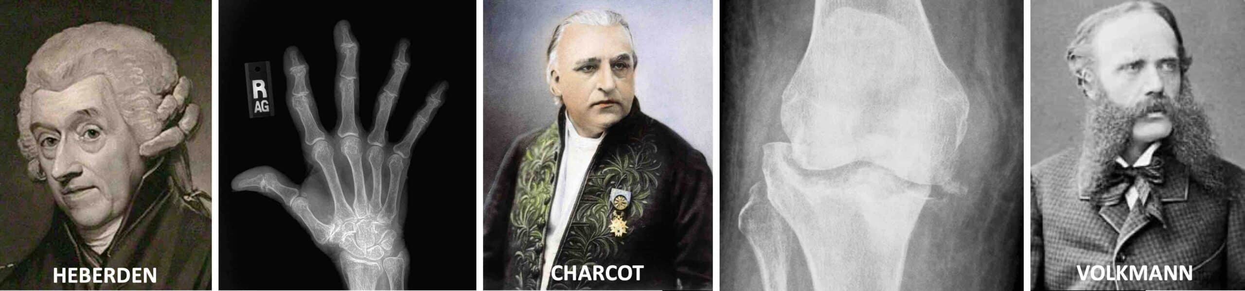 ARTROSE JOELHO SÉCULOS XVIII E XIX