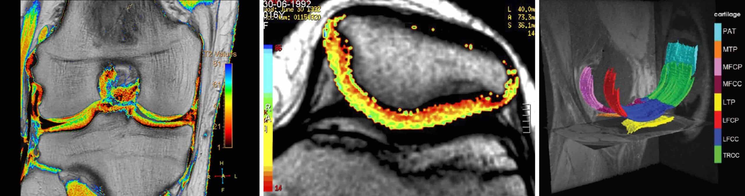 CARTIGRAMA E CONDROMETRIA DO JOELHO CARTIGRAMA E CONDROMETRIA DO JOELHO