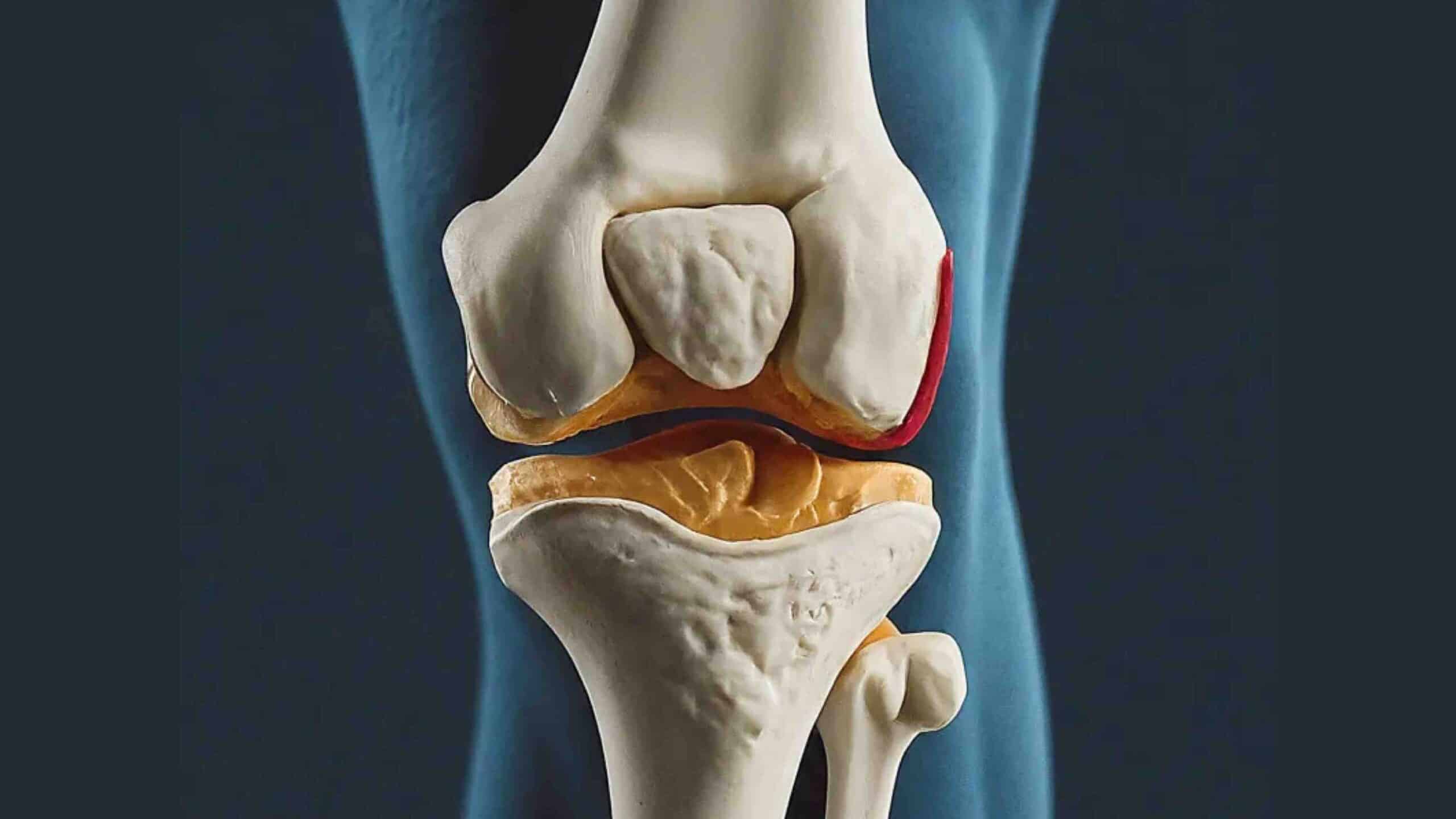 COMO REPOR A CARTILAGEM DO JOELHO COMO REPOR A CARTILAGEM DO JOELHO