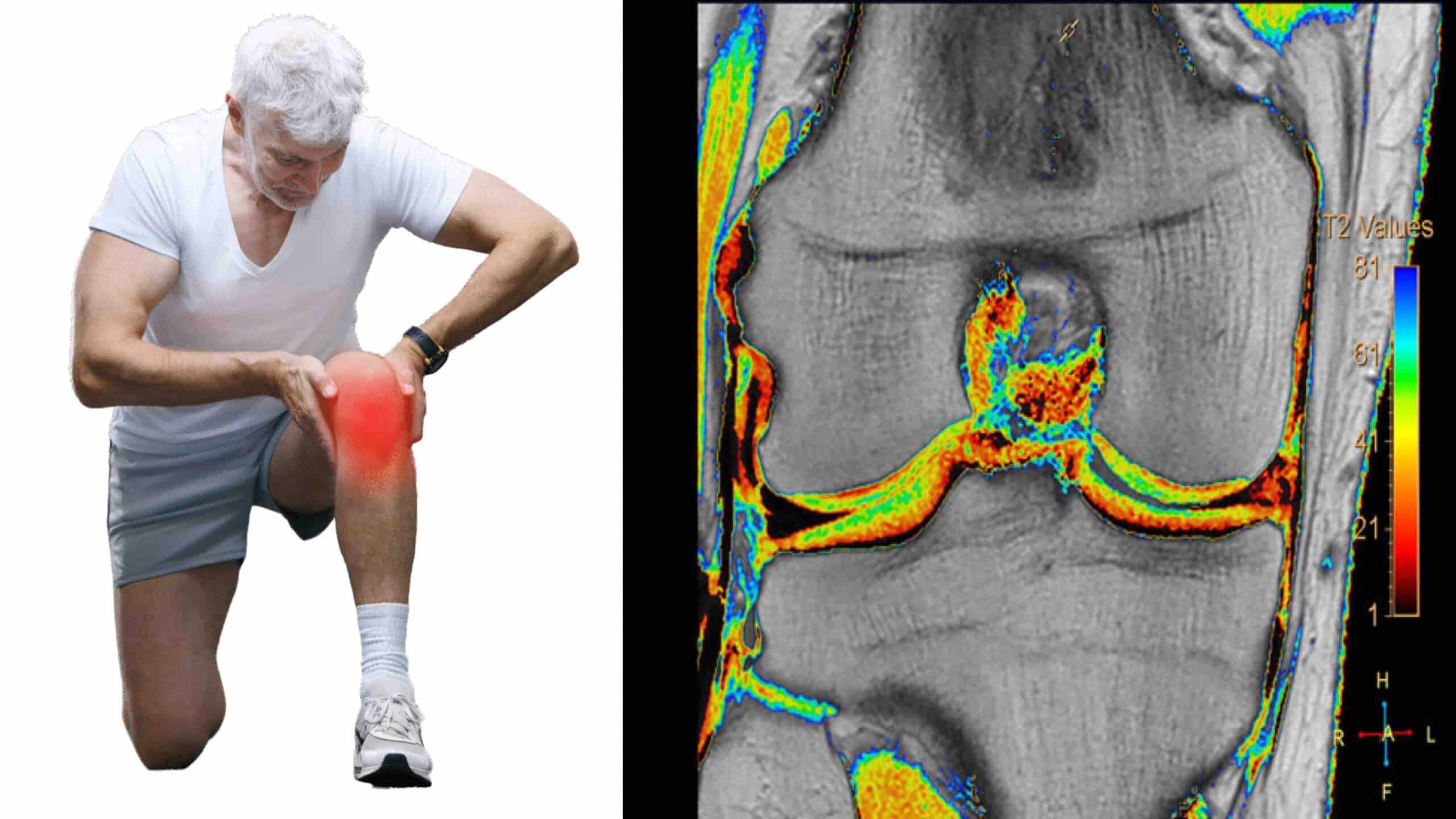 CONDROMETRIA DO JOELHO CONDROMETRIA DO JOELHO