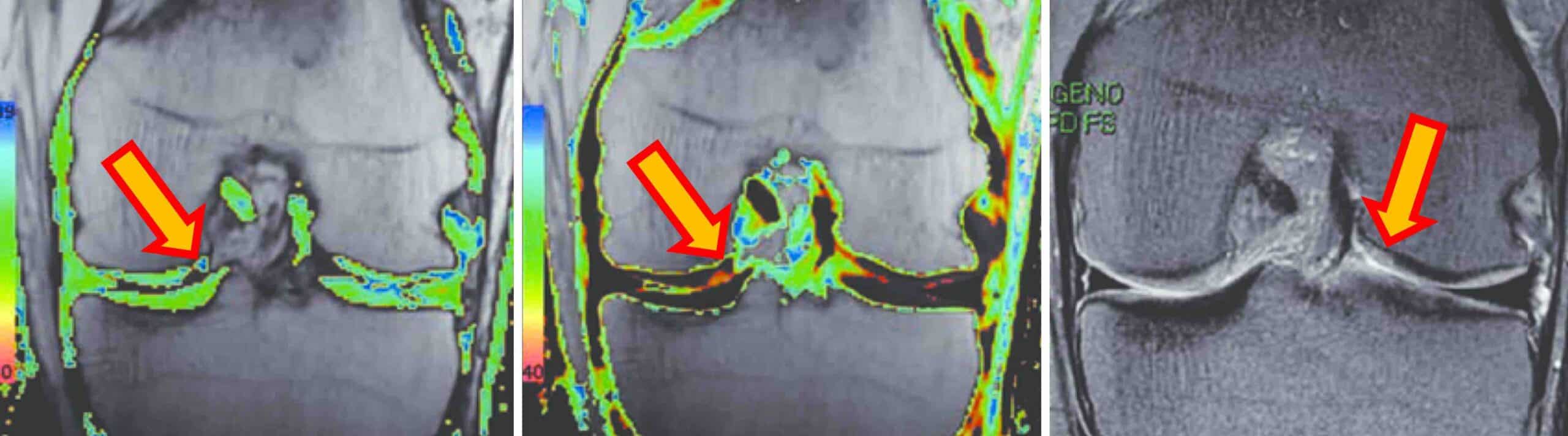 CONDROMETRIA JOELHO CONDROMETRIA JOELHO