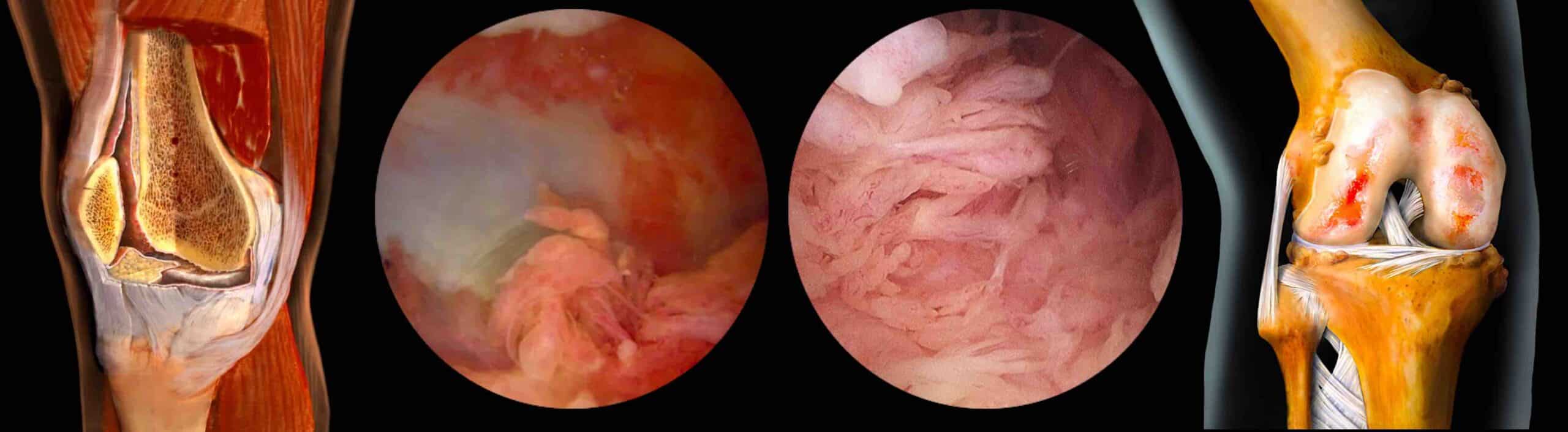 DOENÇA SINOVIAL JOELHO DOENÇA SINOVIAL JOELHO