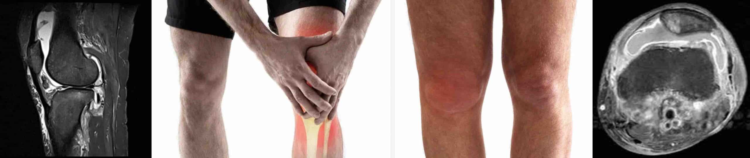 DOENÇAS TECIDO SINOVIAL JOELHO DOENÇAS TECIDO SINOVIAL JOELHO