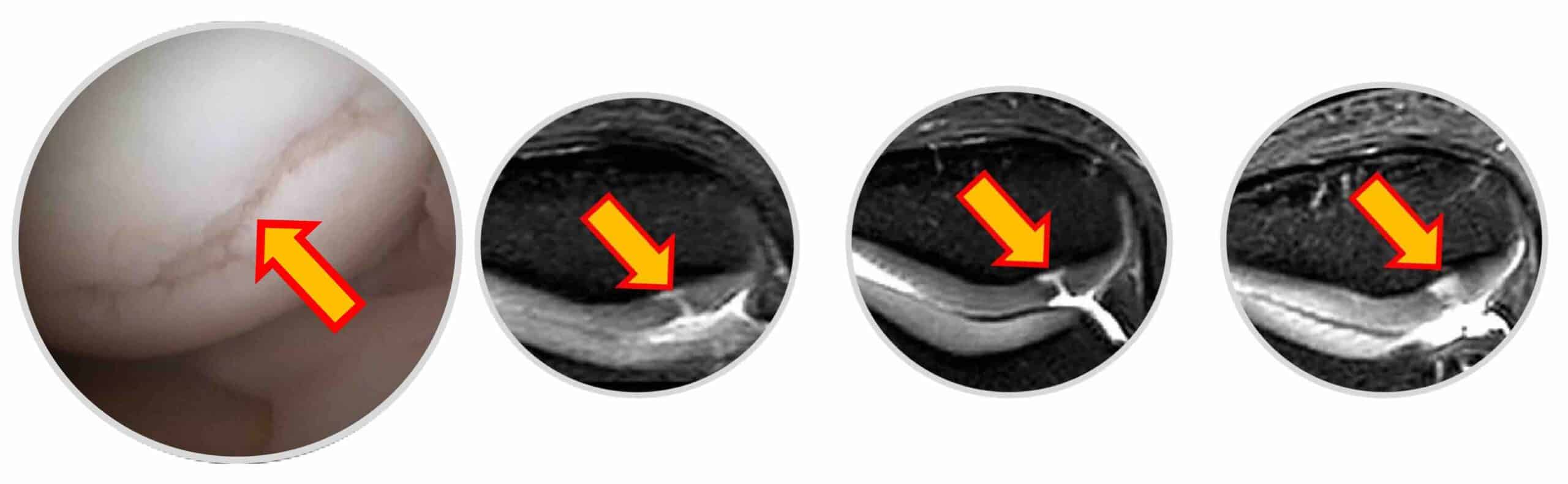FRATURA CONDRAL JOELHO FRATURA CONDRAL JOELHO