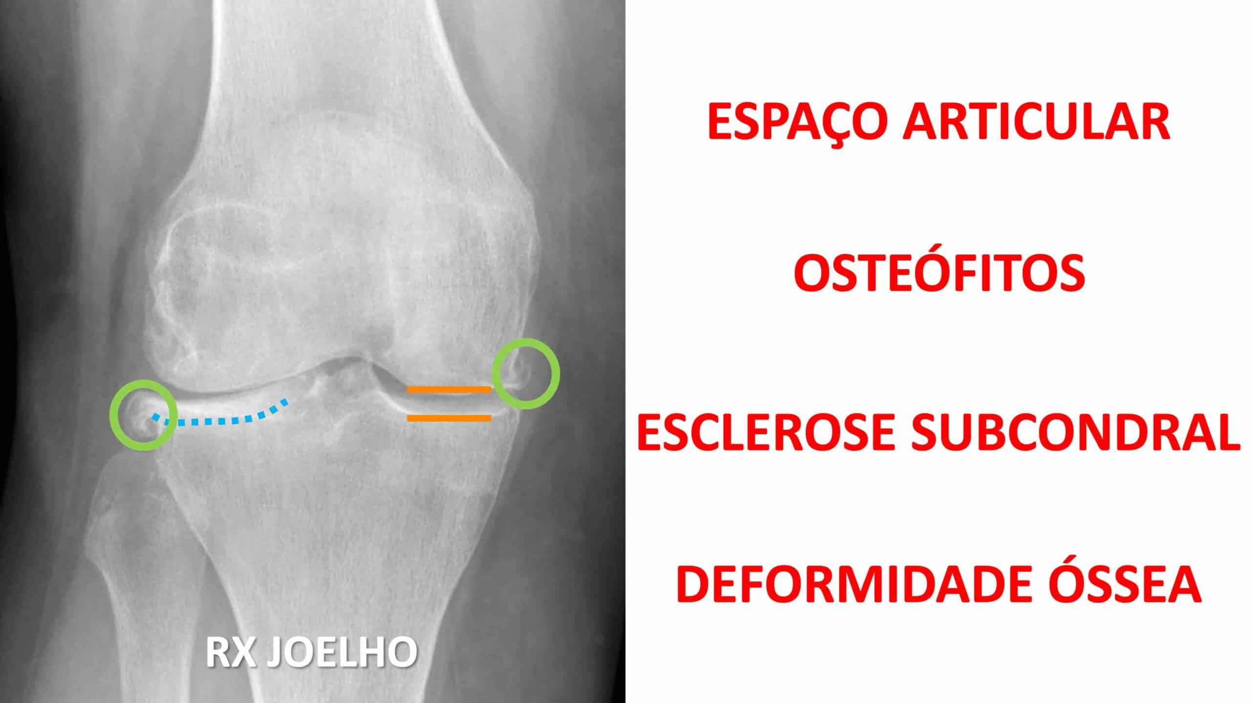GRAU ARTROSE JOELHO GRAU ARTROSE JOELHO