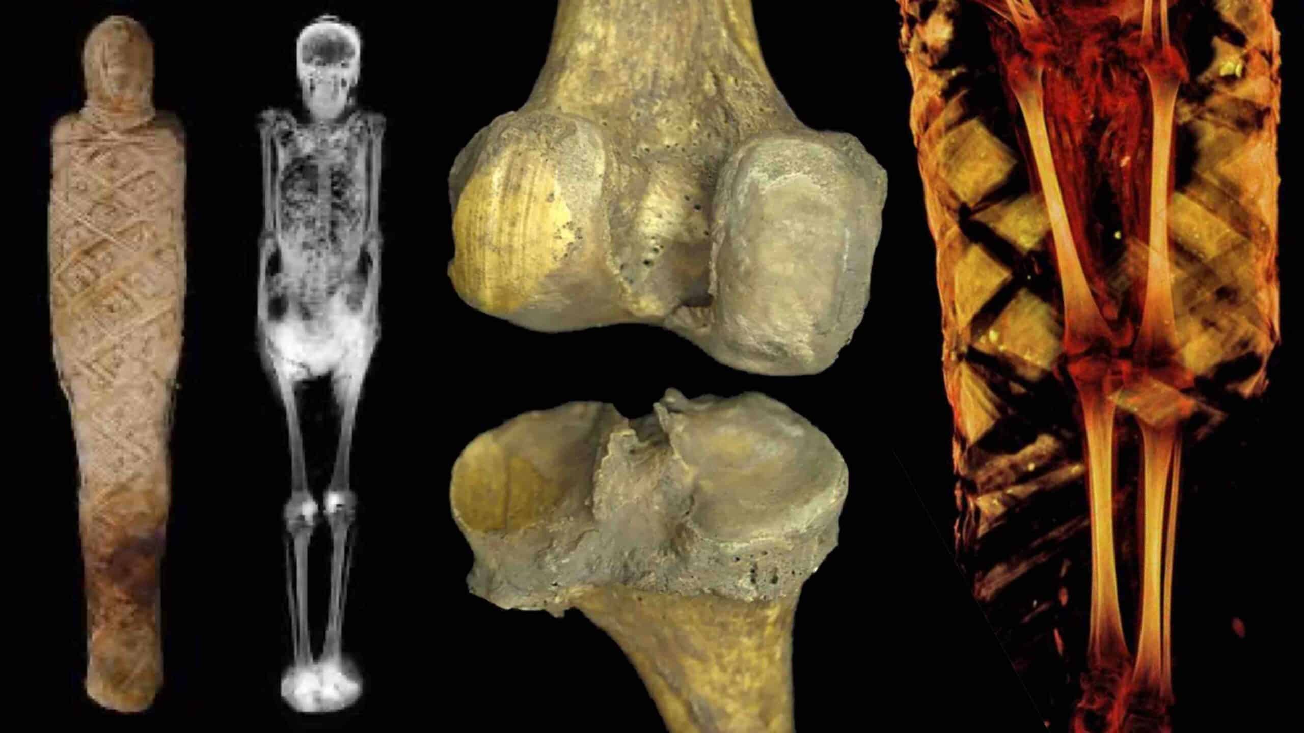 HISTÓRIA DA ARTROSE DO JOELHO