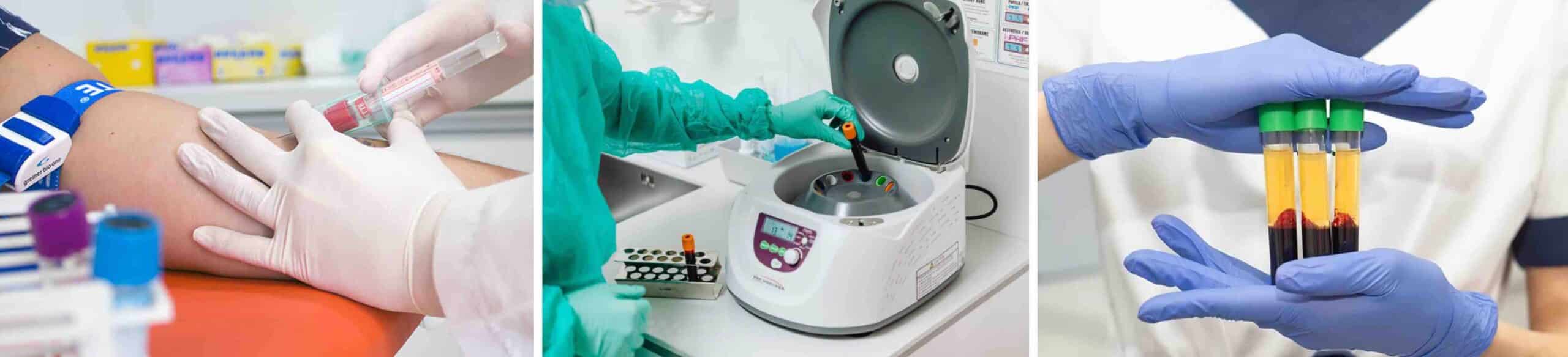 OBTENÇÃO DO PRP PARA O JOELHO OBTENÇÃO DO PRP PARA O JOELHO