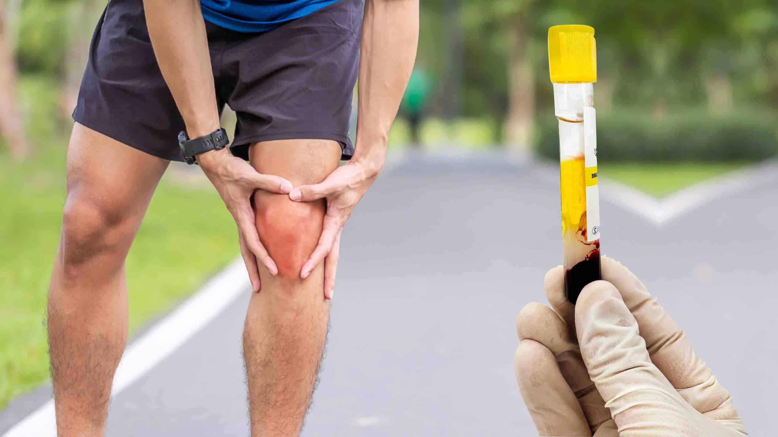 PRP PLASMA RICO EM PLAQUETAS PARA O JOELHO PRP PLASMA RICO EM PLAQUETAS PARA O JOELHO