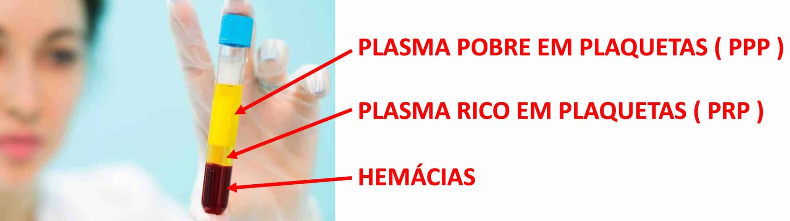 PRP PLASMA RICO EM PLAQUETAS PRP PLASMA RICO EM PLAQUETAS