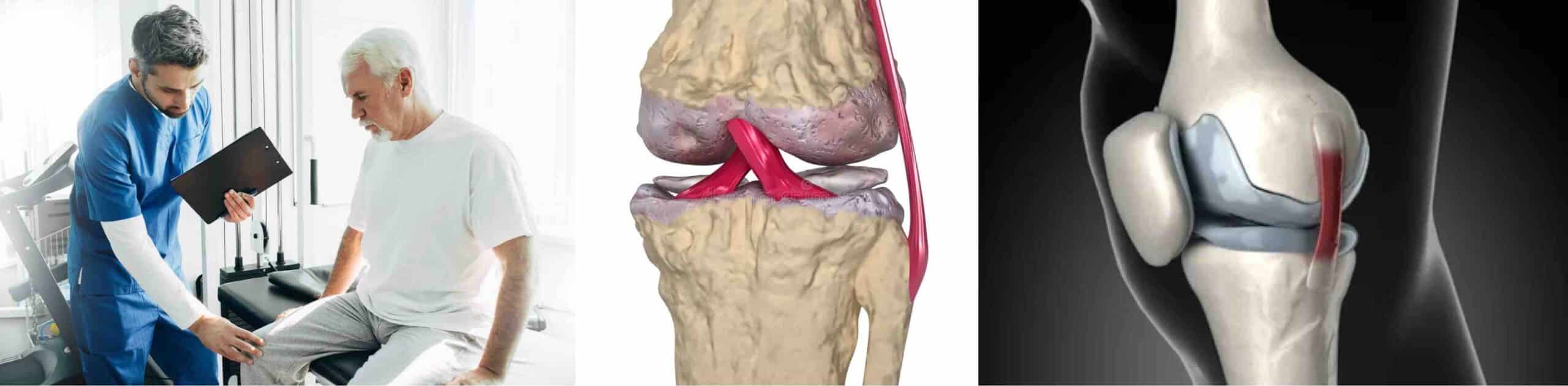 REPOR CARTILAGEM JOELHO REPOR CARTILAGEM JOELHO