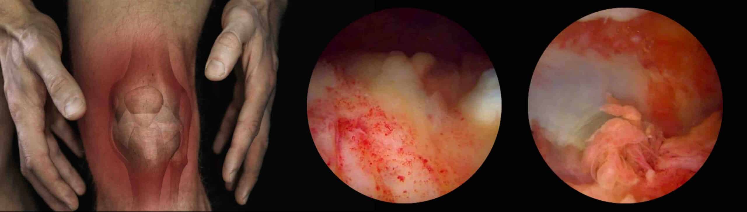 SINOVITE CRÔNICA IDIOPÁTICA JOELHO SINOVITE CRÔNICA IDIOPÁTICA JOELHO