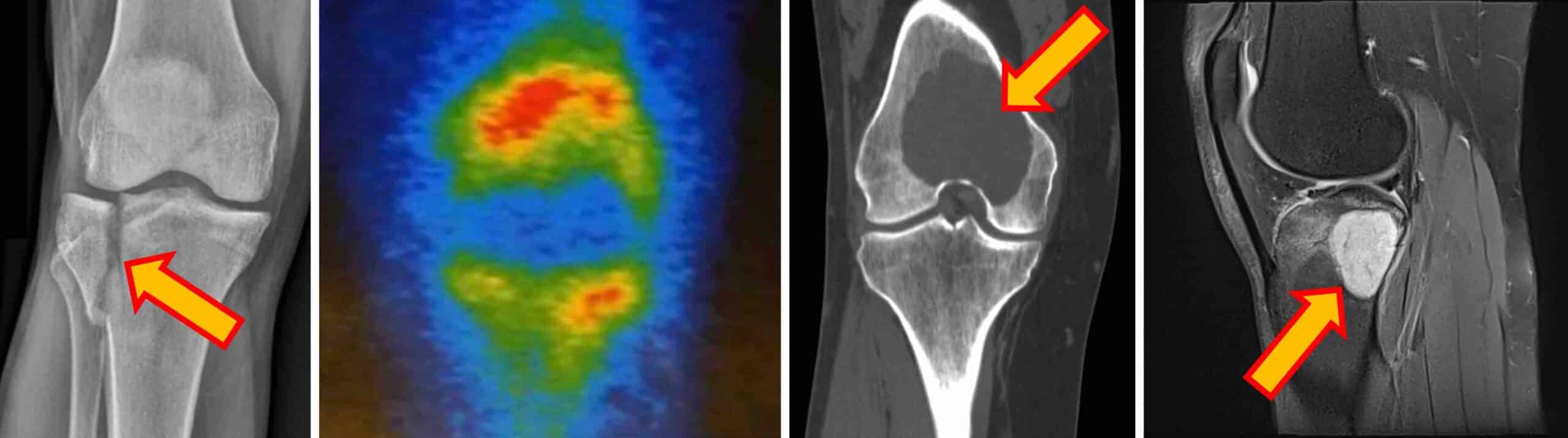DOR JOELHO ORIGEM ÓSSEA DOR JOELHO ORIGEM ÓSSEA
