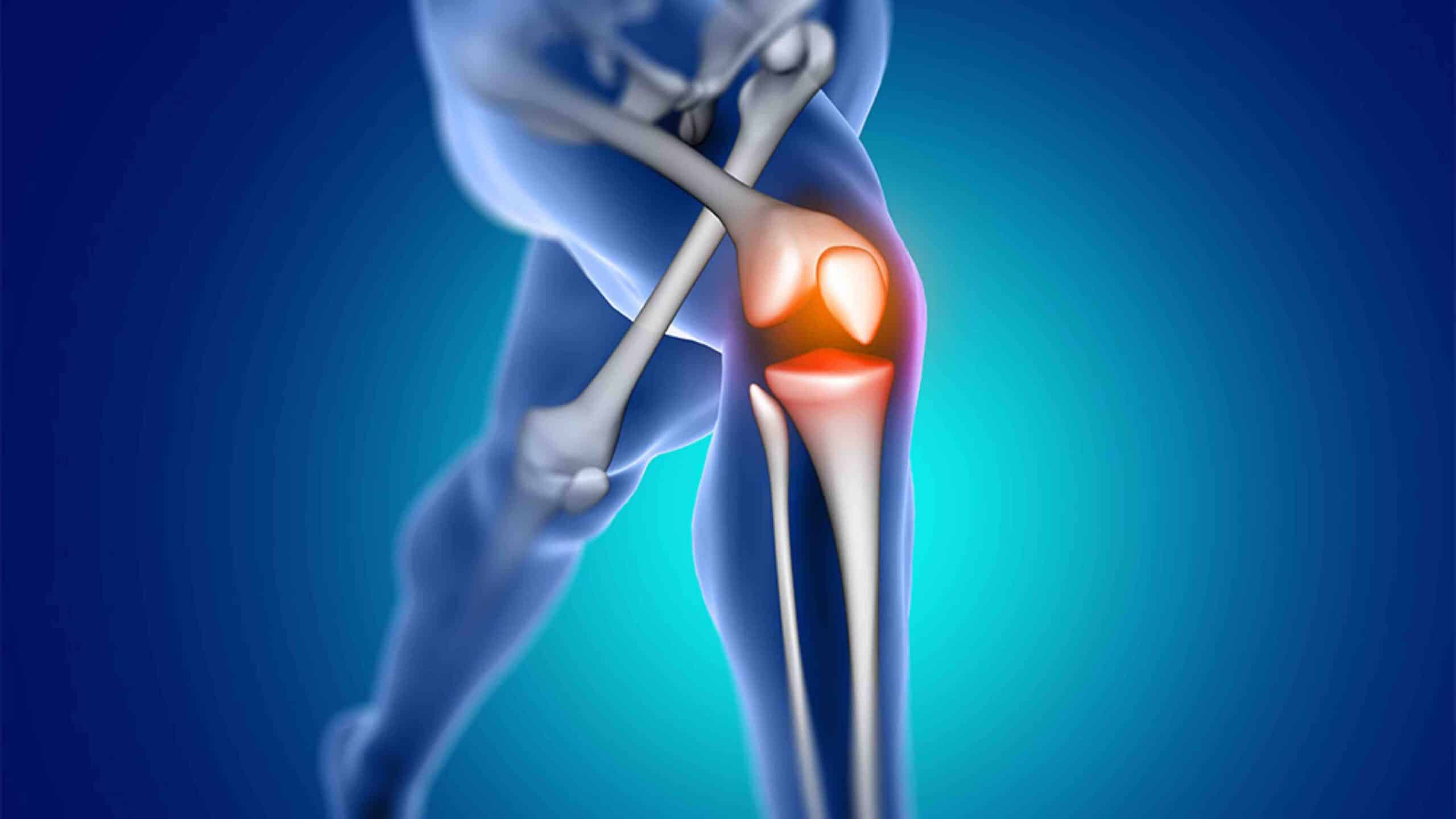 DOR NO JOELHO DE ORIGEM ÓSSEA DOR NO JOELHO DE ORIGEM ÓSSEA