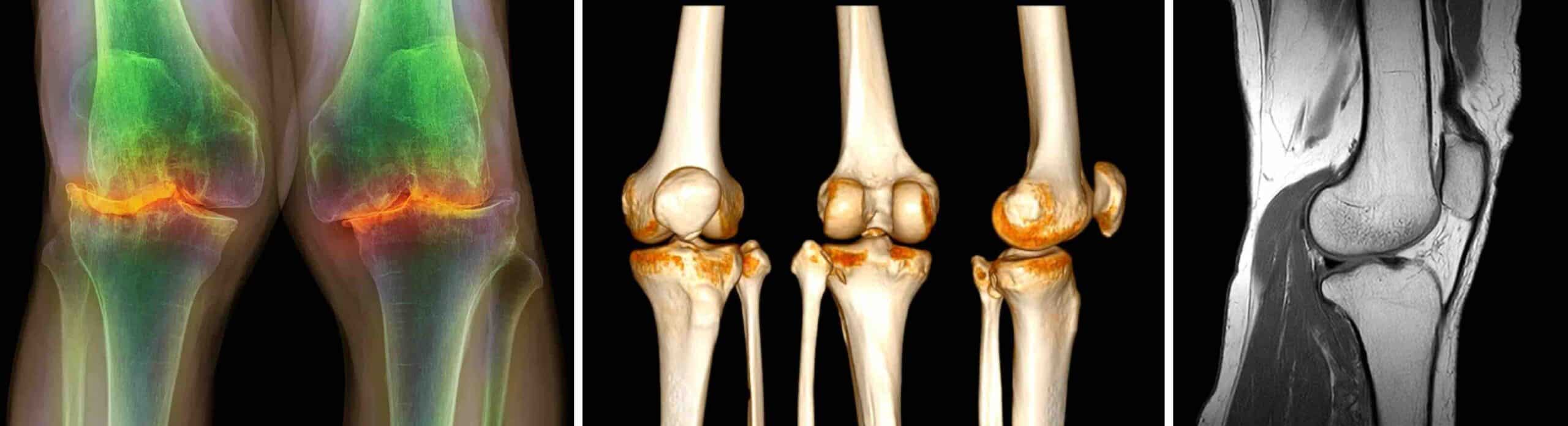 DOR ÓSSEA JOELHO DOR ÔSSEA JOELHO