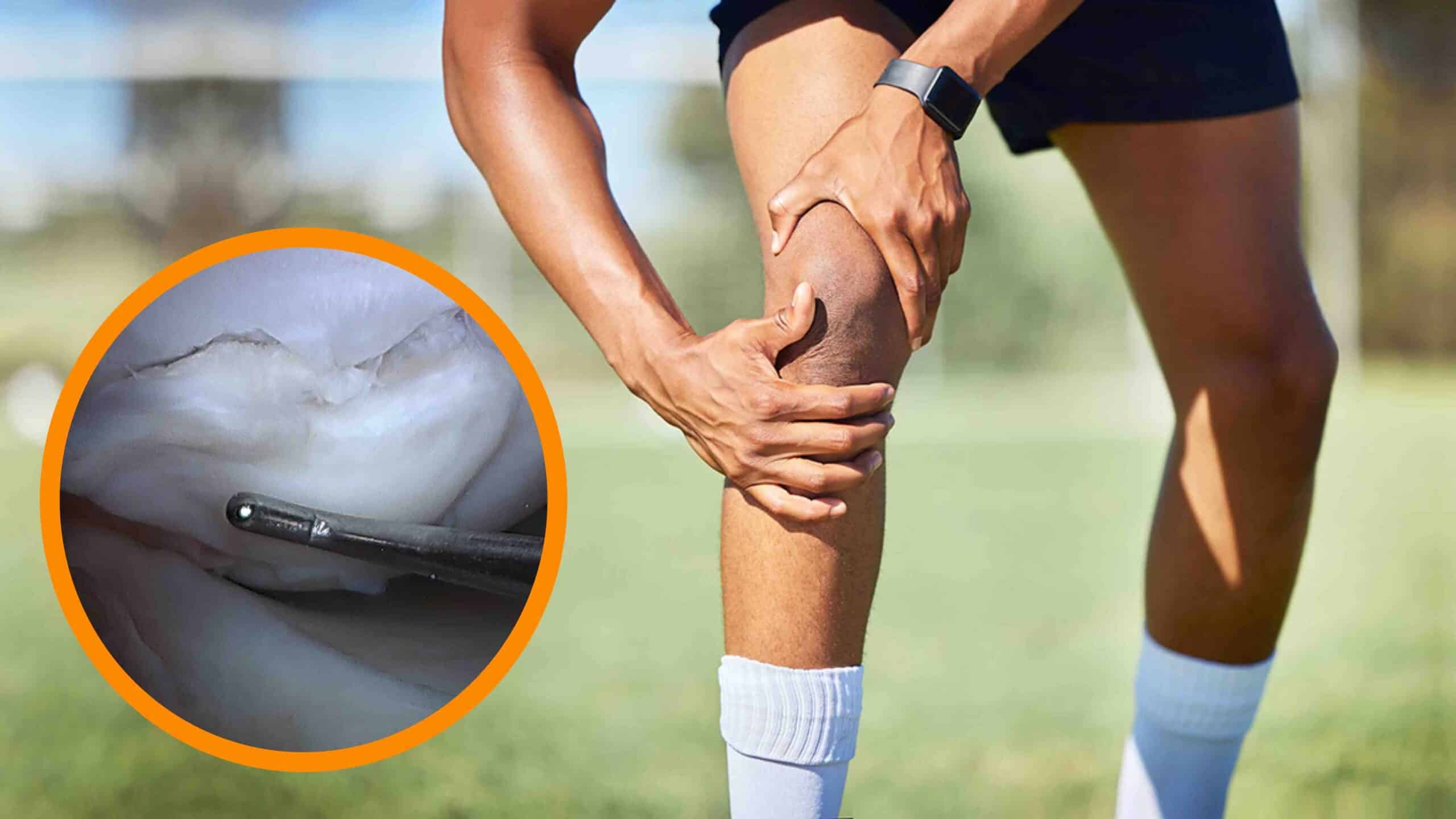 FRATURA OSTEOCONDRAL DO JOELHO FRATURA OSTEOCONDRAL DO JOELHO