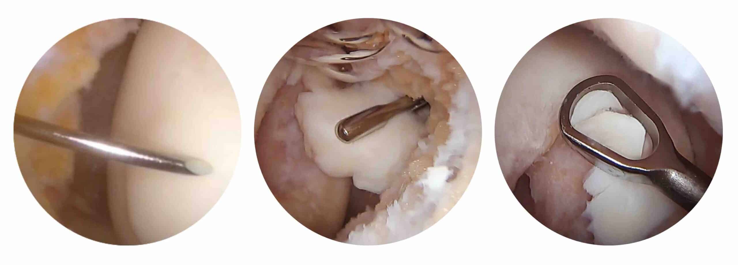 FRATURA OSTEOCONDRAL JOELHO FRATURA OSTEOCONDRAL JOELHO
