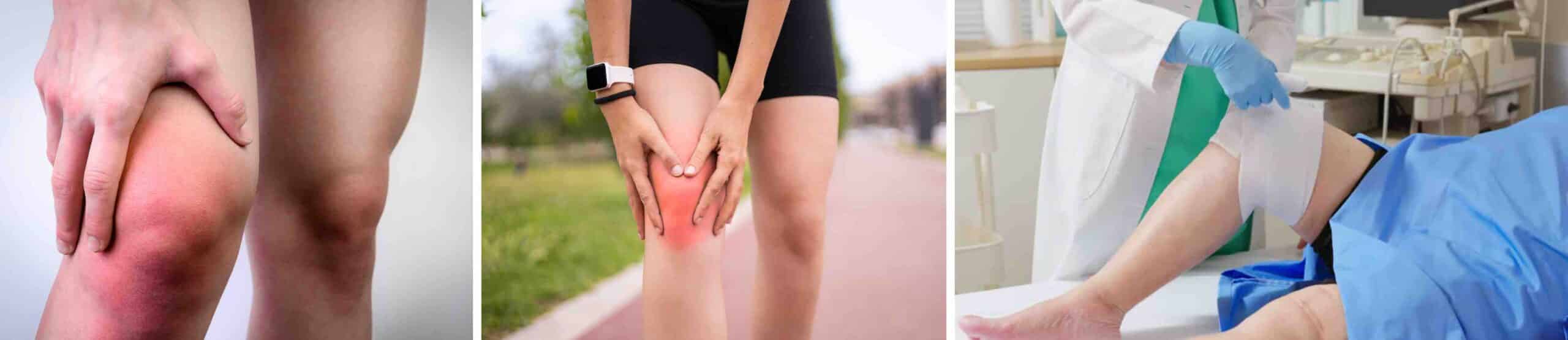 INCHAÇO RECORRENTE JOELHO