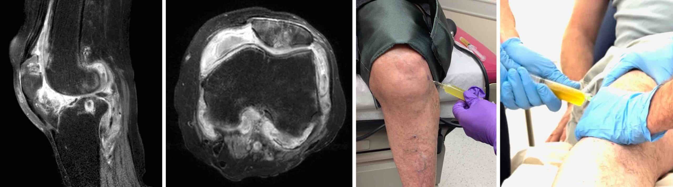 INCHAÇO REPETITIVO JOELHO