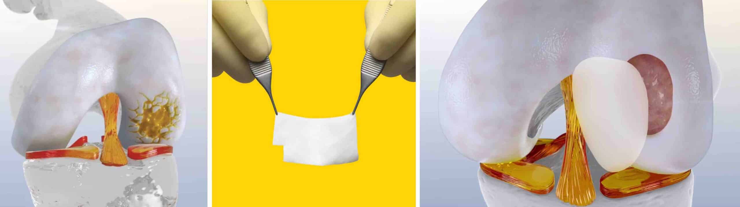 MEMBRANA CARTILAGEM JOELHO