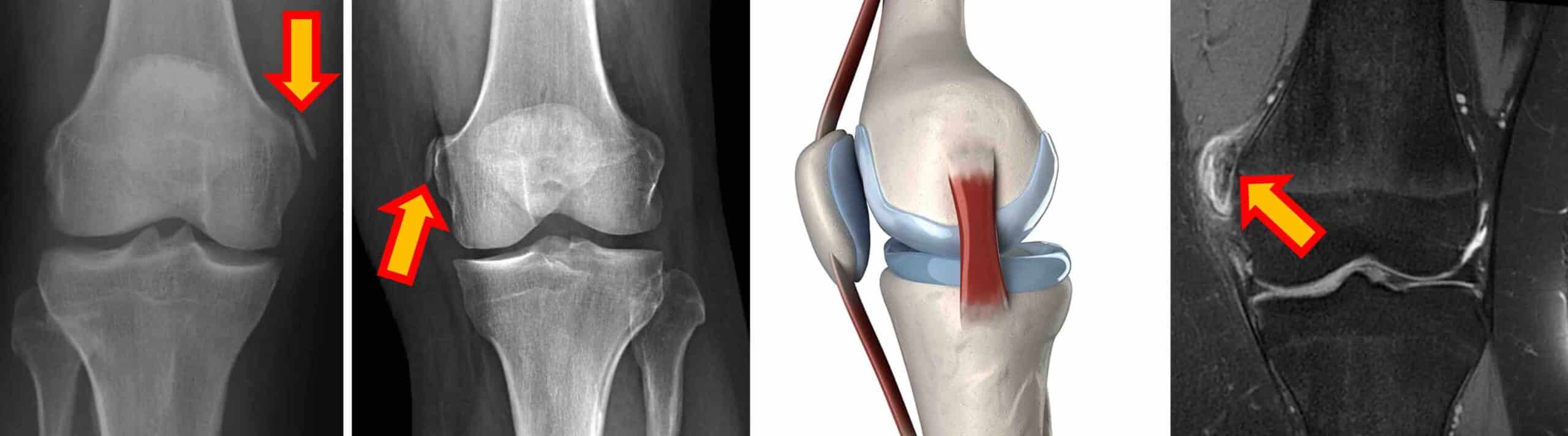 PELLEGRINI-STIEDA PELLEGRINI-STIEDA