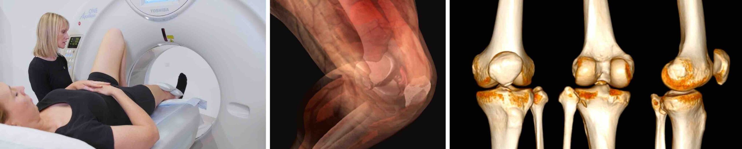 TOMOGRAFIA DO JOELHO TOMOGRAFIA DO JOELHO