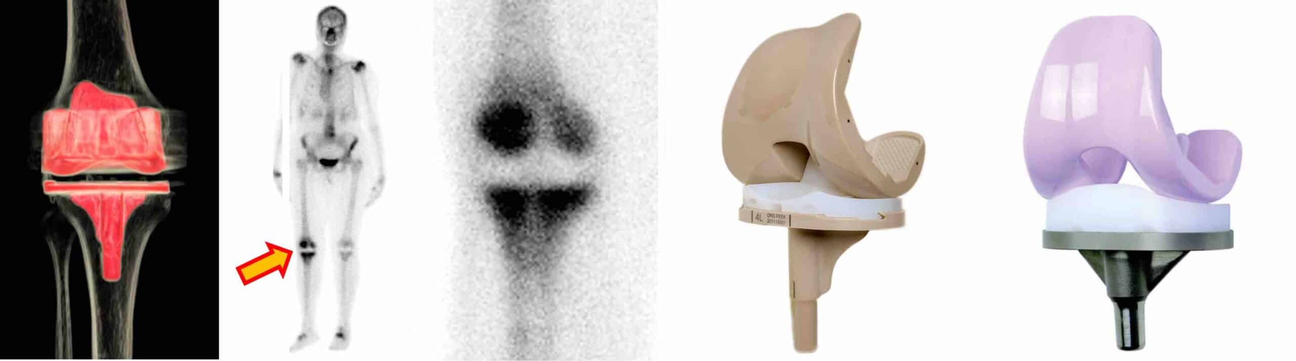 ALERGIA PRÓTESE JOELHO