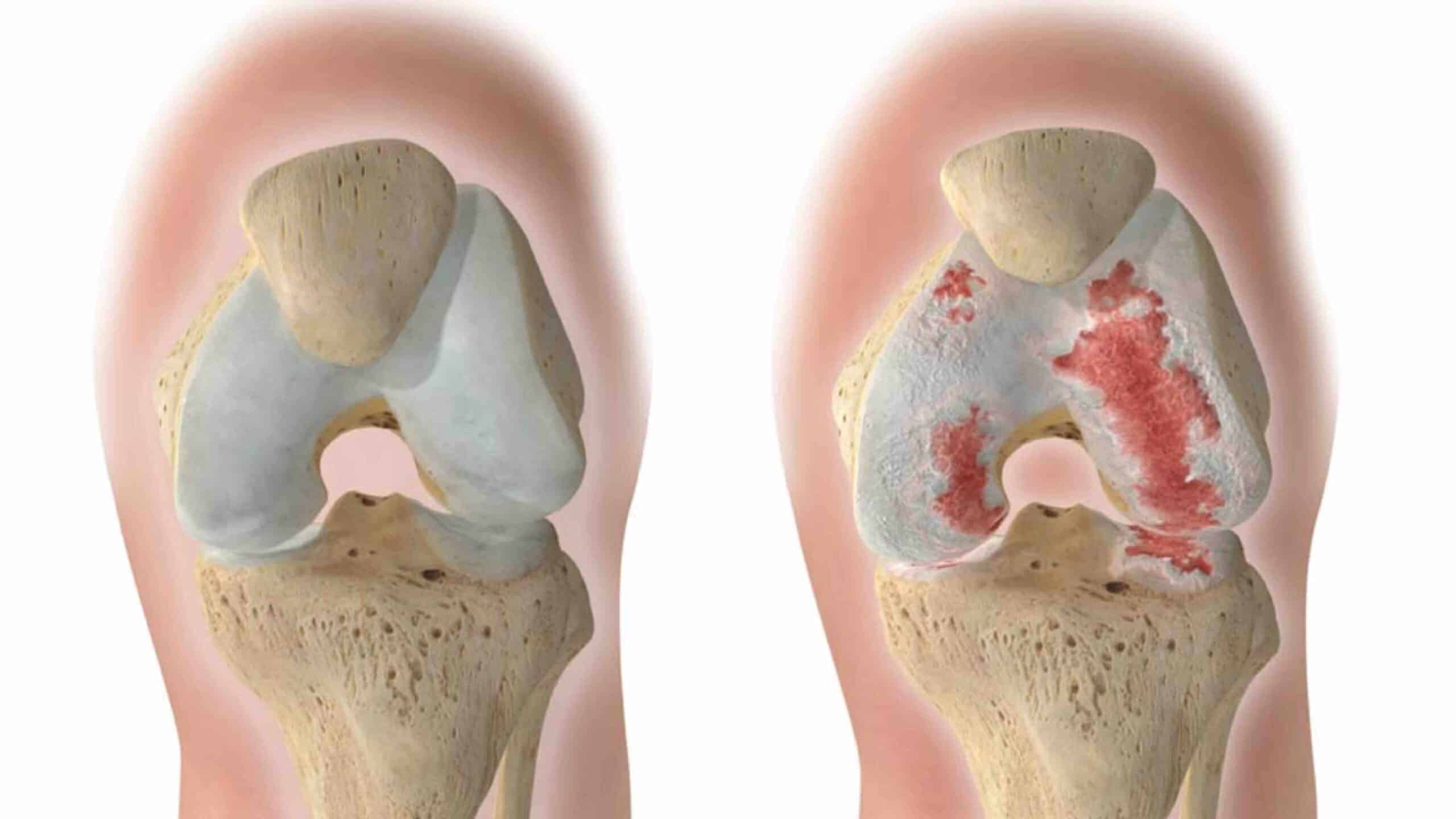 ARTROSE NO JOELHO TEM CURA?