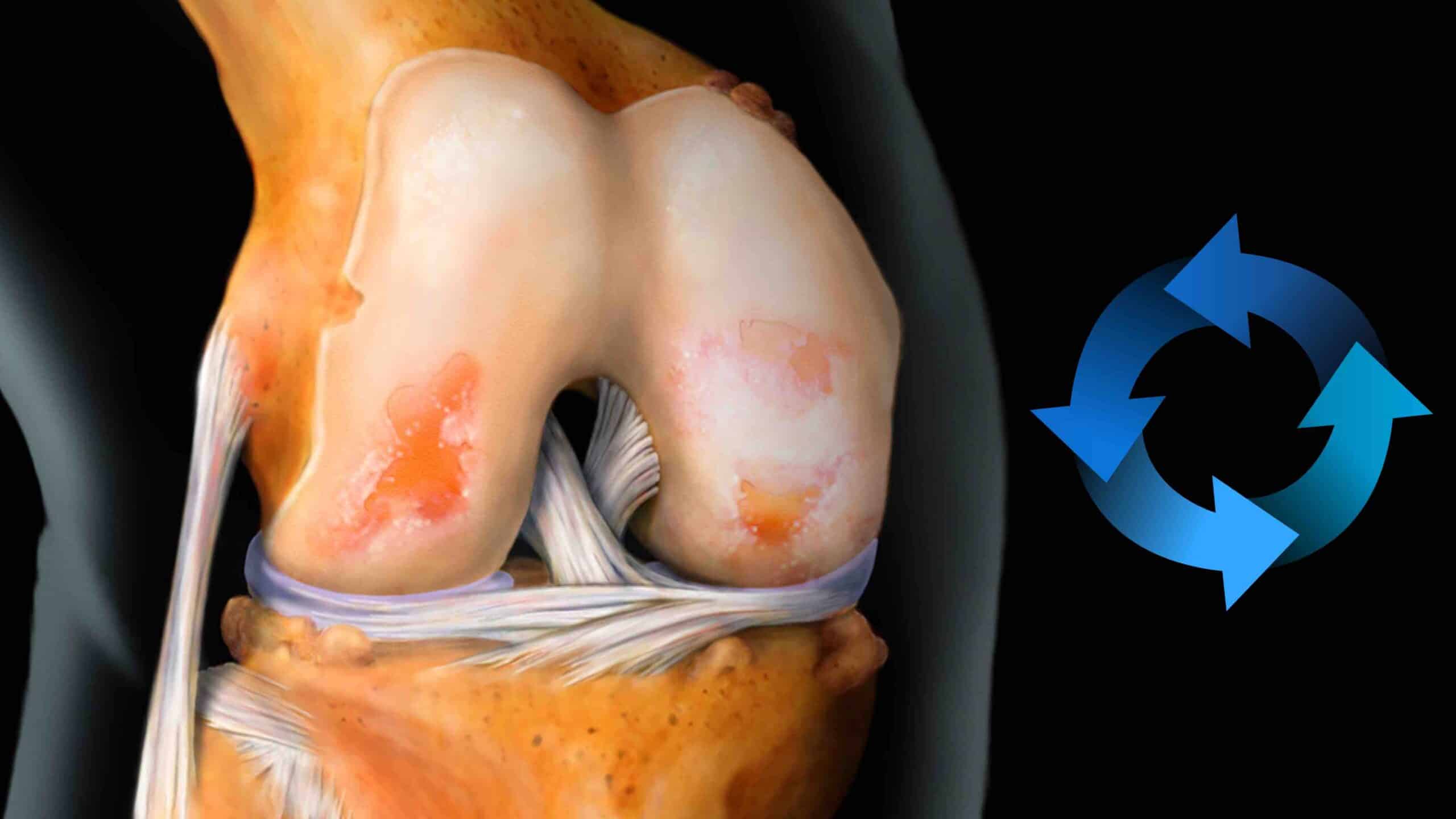 CÍRCULO VICIOSO DA DOR DA ARTROSE DO JOELHO