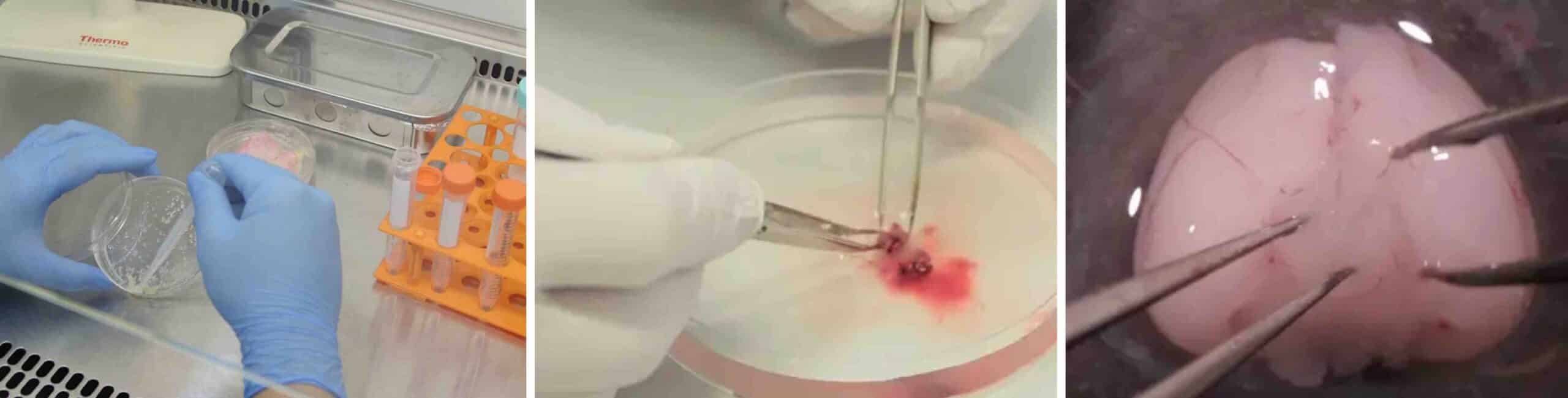 CONDRÓCITOS CARTILAGEM JOELHO