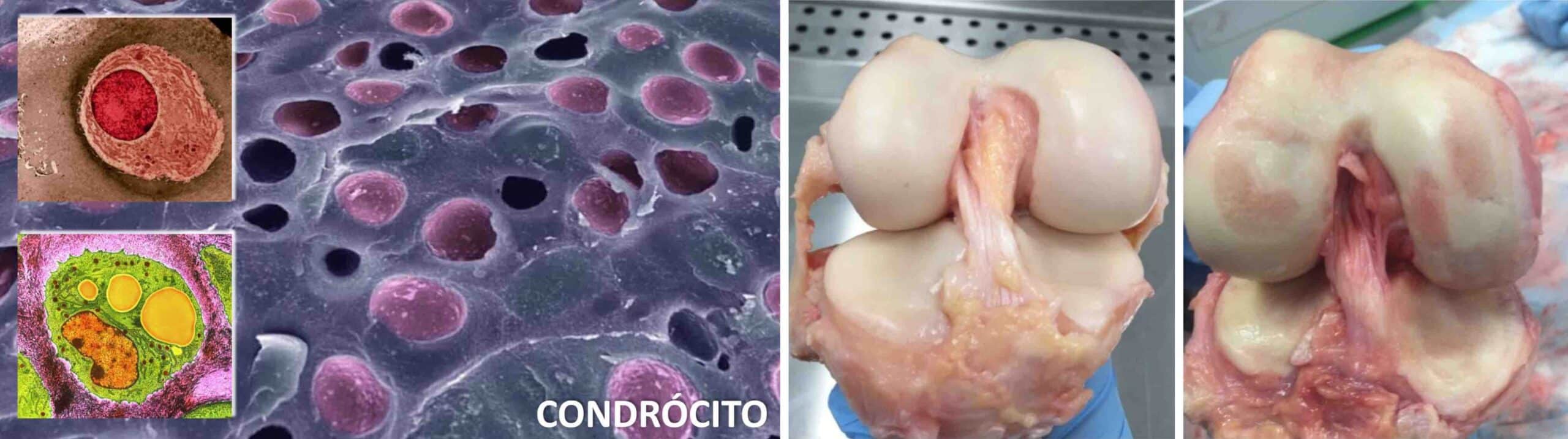 CONDRÓCITOS JOELHO