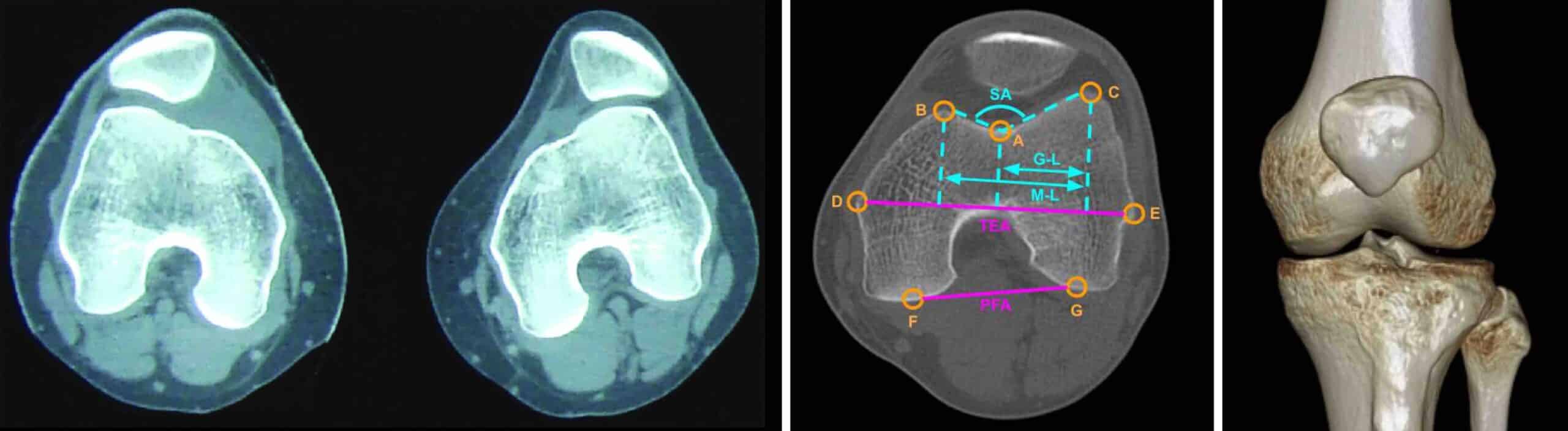 INSTABILIDADE PATELOFEMORAL JOELHO INSTABILIDADE PATELOFEMORAL JOELHO