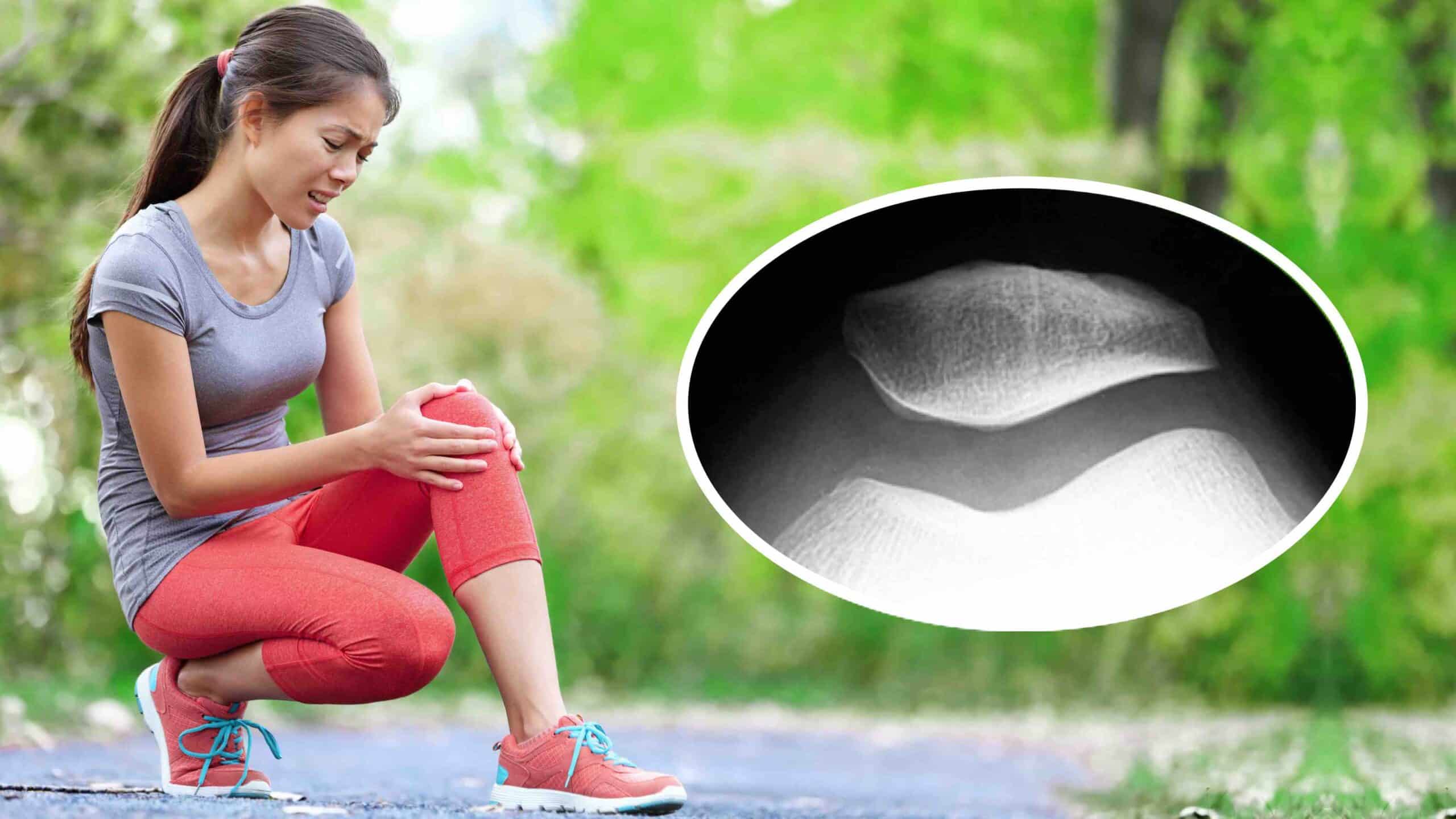 INSTABILIDADE PATELOFEMORAL INSTABILIDADE PATELOFEMORAL