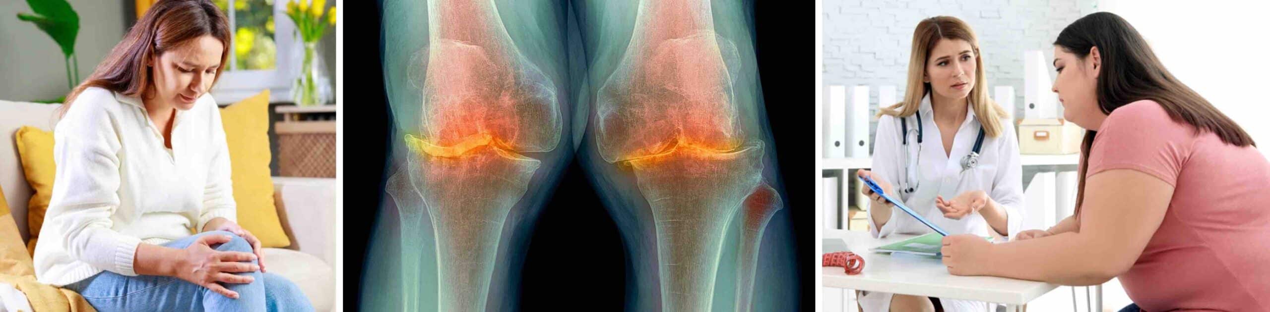 ARTROSE NO JOELHO PESO CORPORAL