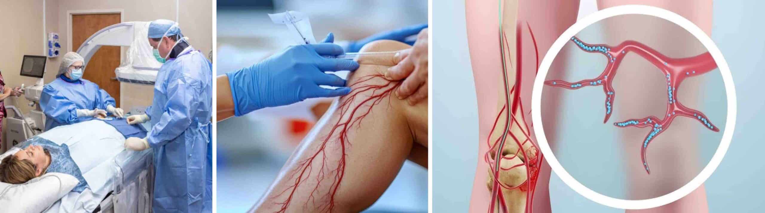 EMBOLIZAÇÃO ARTÉRIA GENICULAR