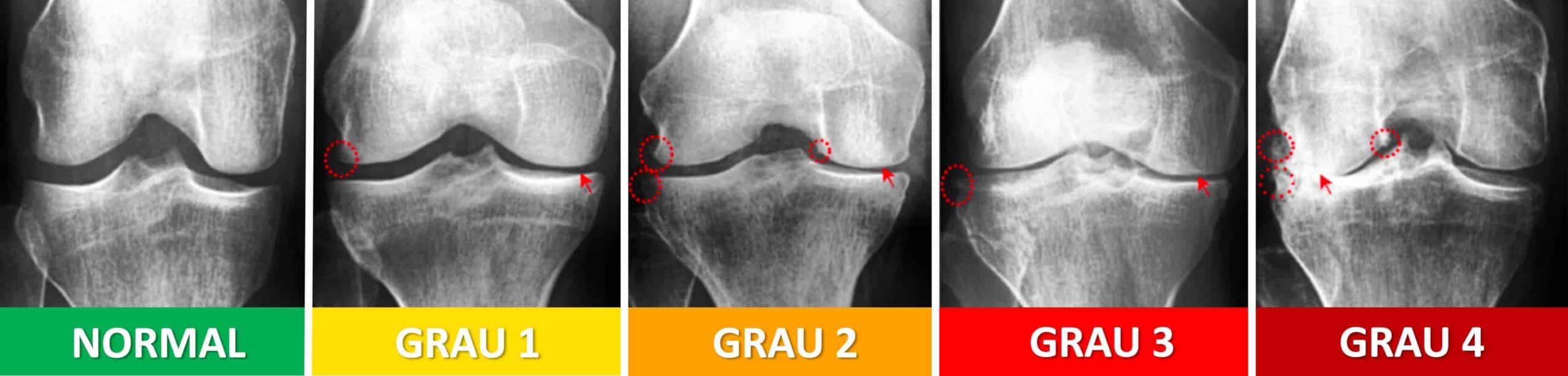 GRAUS DA ARTROSE JOELHO