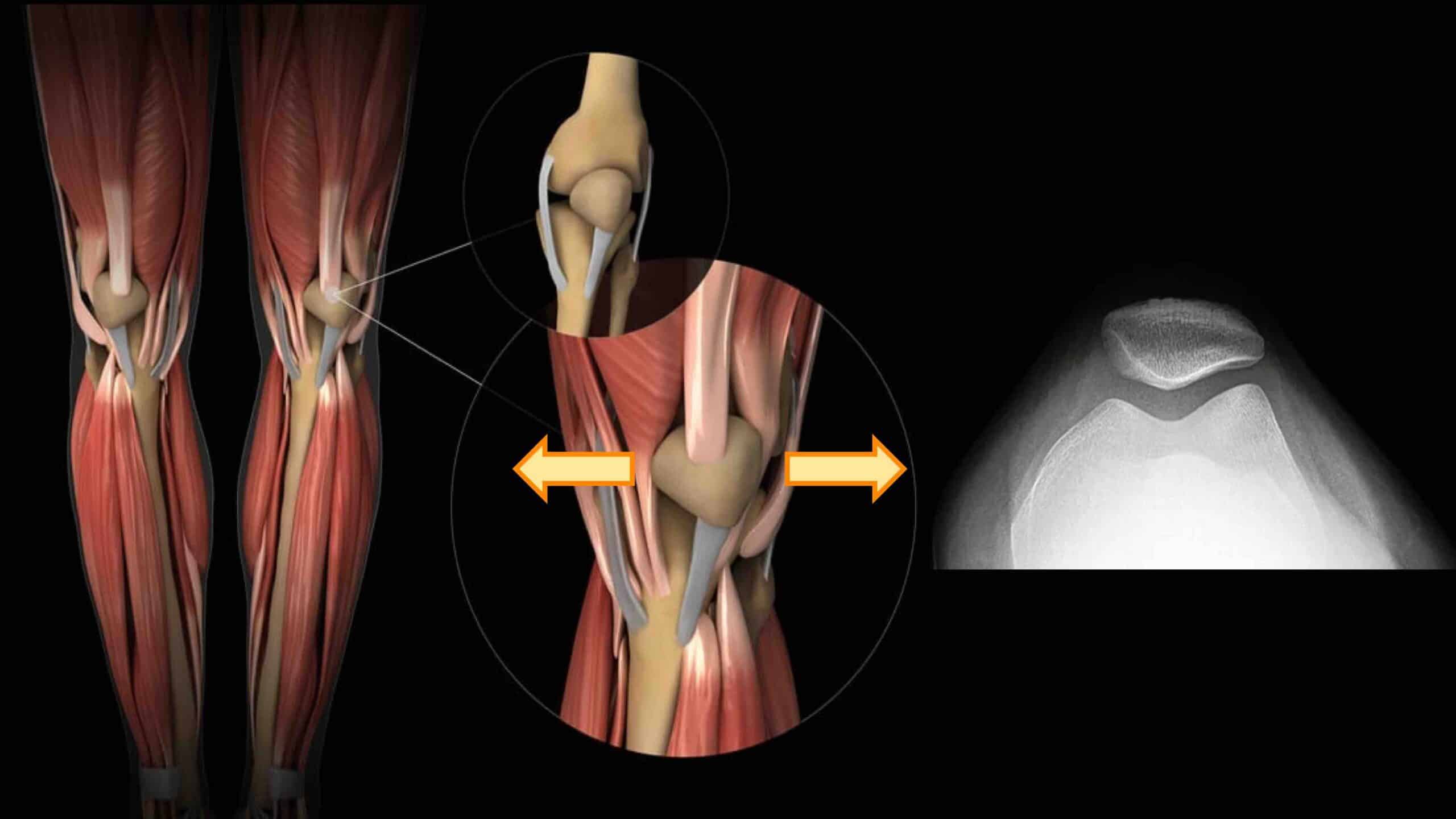 HIPERMOBILIDADE DA PATELA HIPERMOBILIDADE DA PATELA