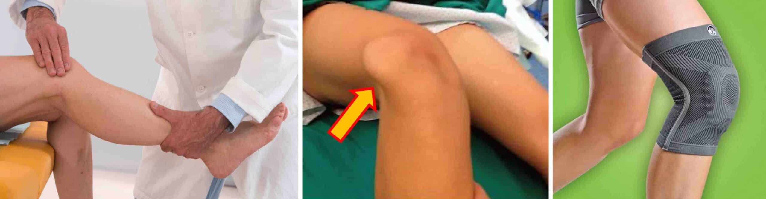 HIPERMOBILIDADE PATELA HIPERMOBILIDADE PATELA