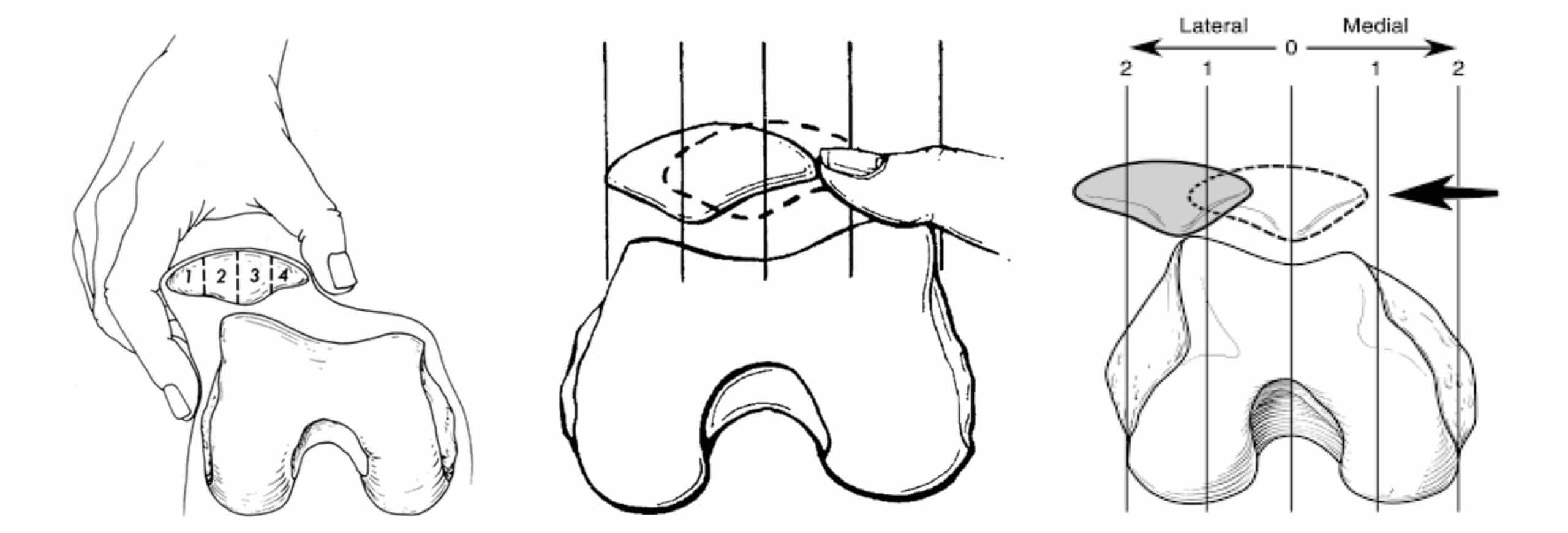 HIPERMOBILIDADE PATELAR HIPERMOBILIDADE PATELAR