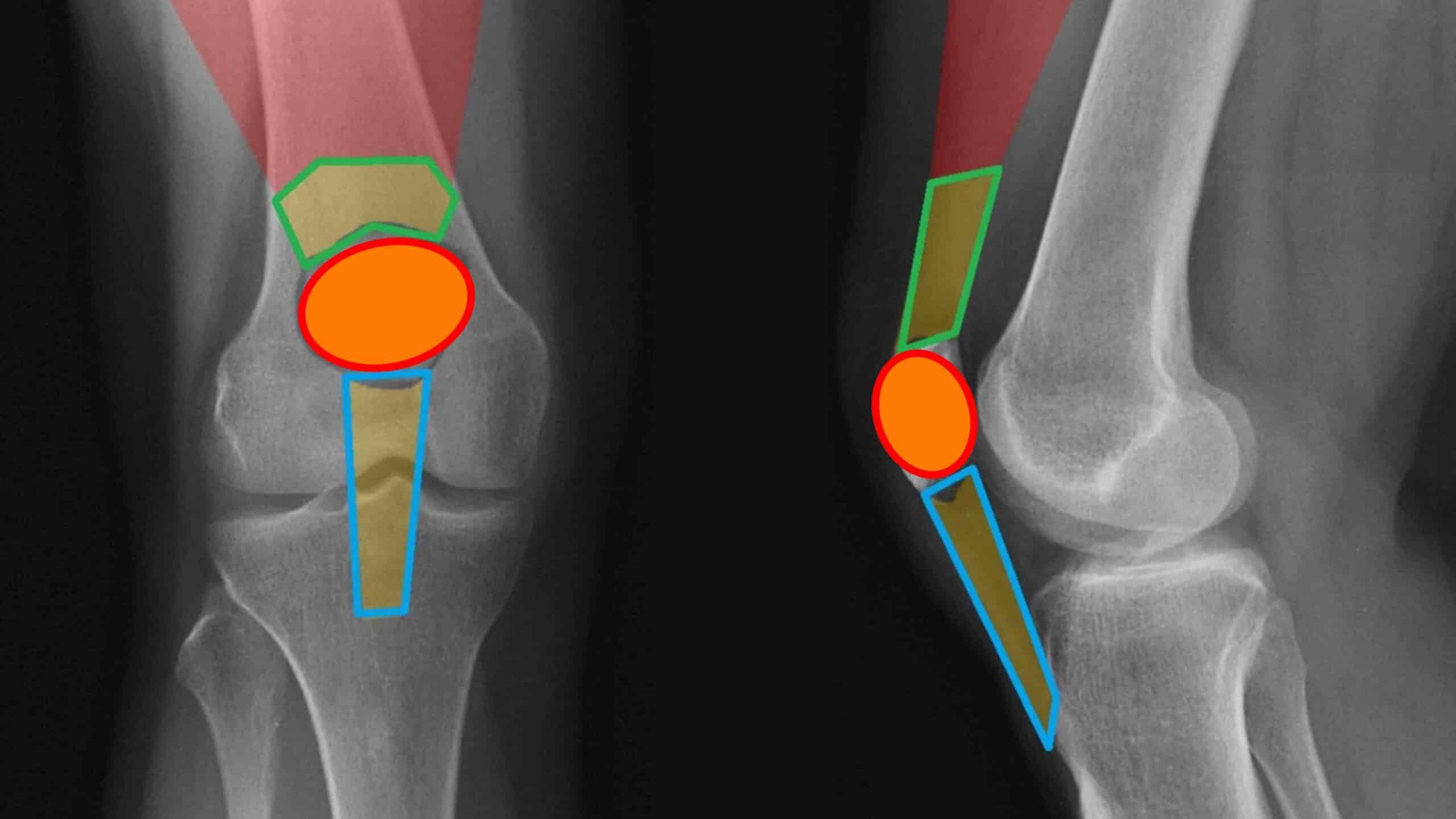 PATELECTOMIA PATELECTOMIA