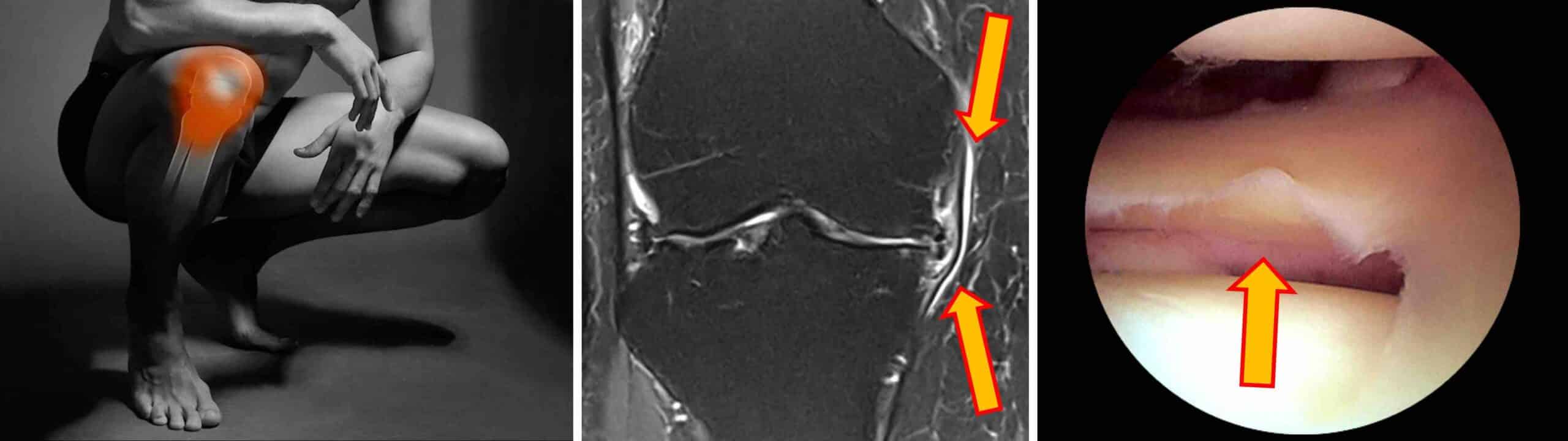 PERIMENISCITE JOELHO