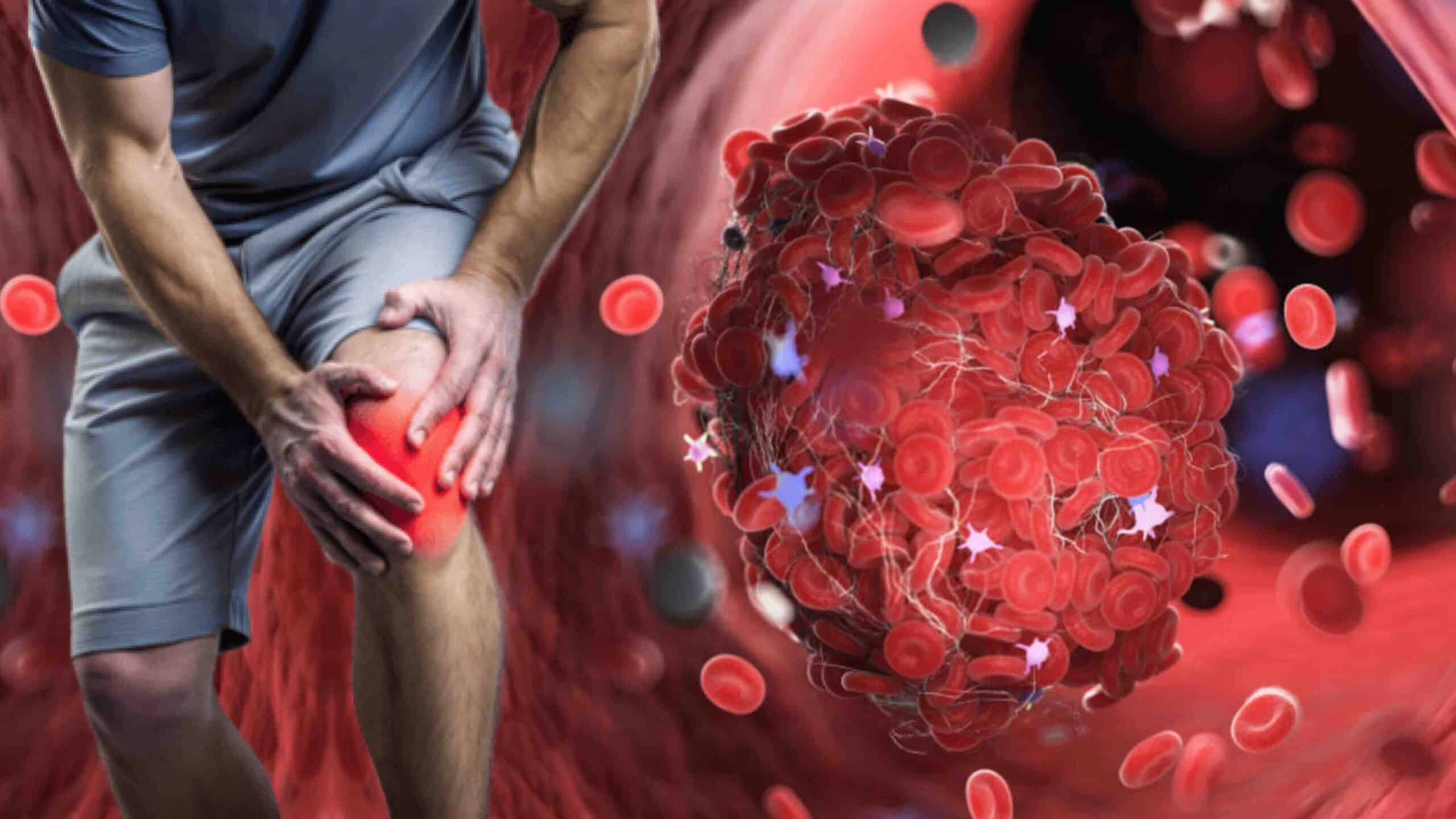 SÍNDROME ANTIFOSFOLÍPEDE NO JOELHO