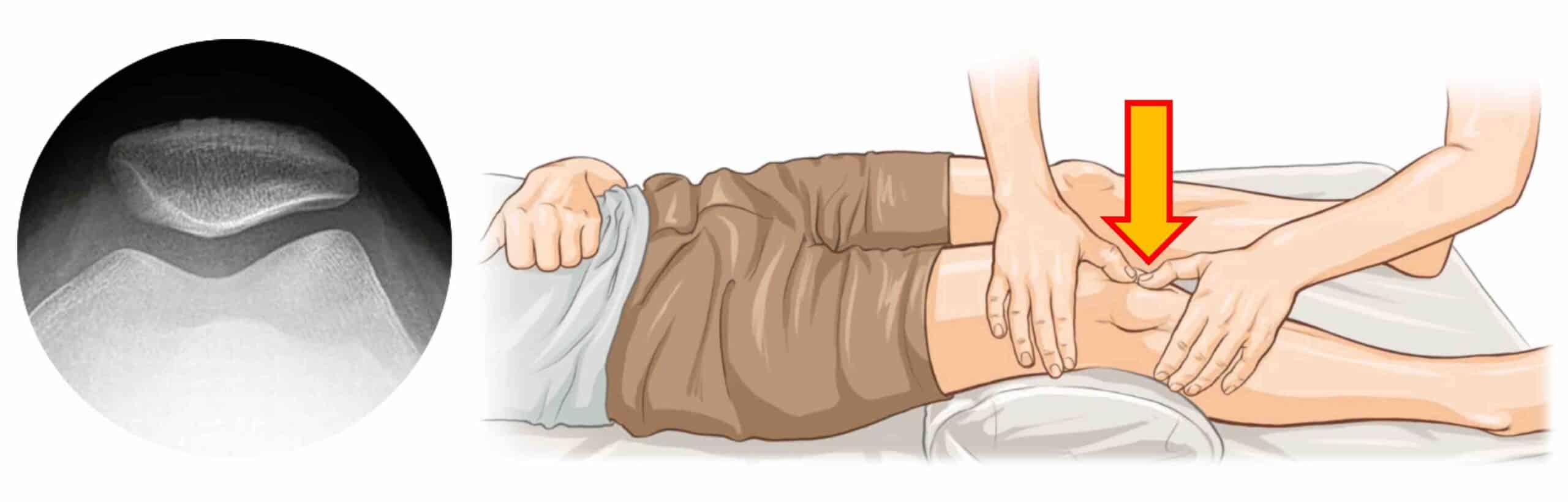 TESTE APREENSÃO PATELAR TESTE APREENSÃO PATELAR