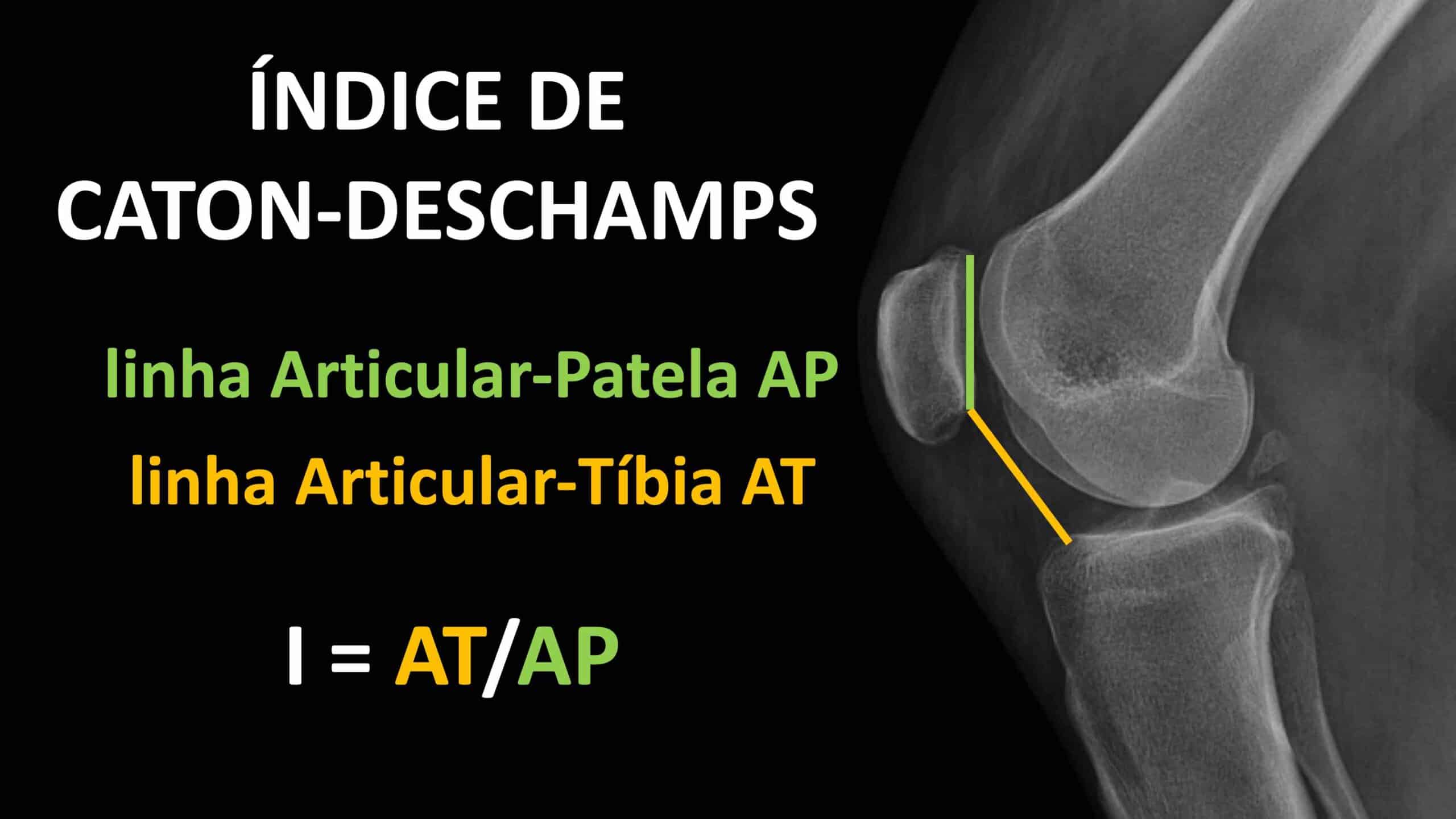 COMO MEDIR O ÍNDICE DE CATON-DESCHAMPS
