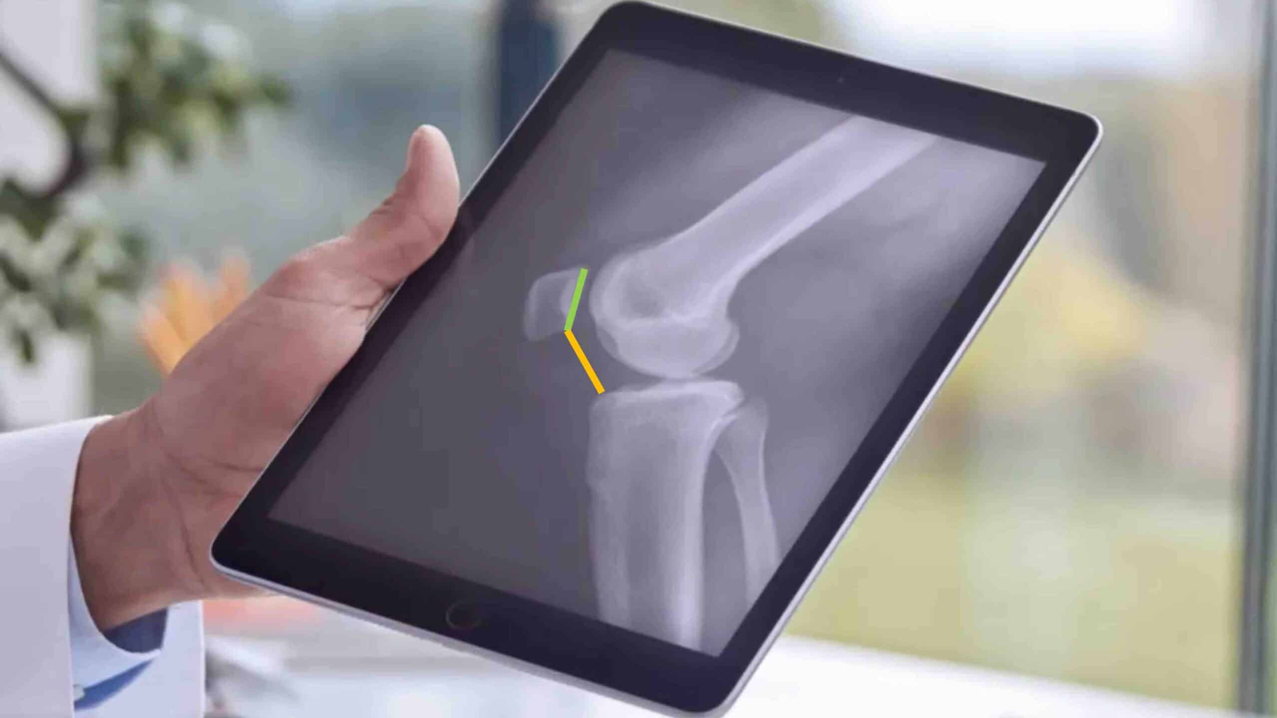 ÍNDICE DE CATON-DESCHAMPS