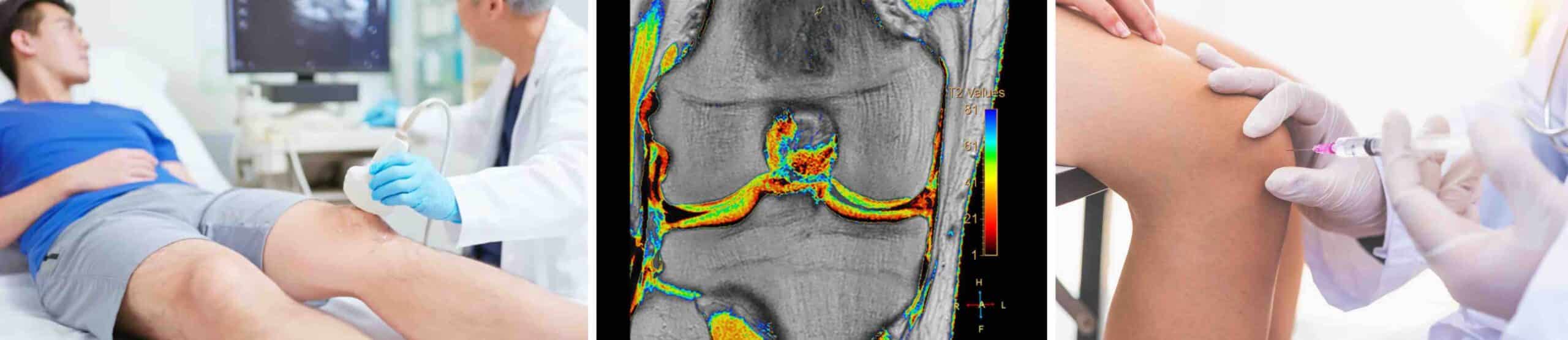 INJEÇÃO ANTIENVELHECIMENTO JOELHO