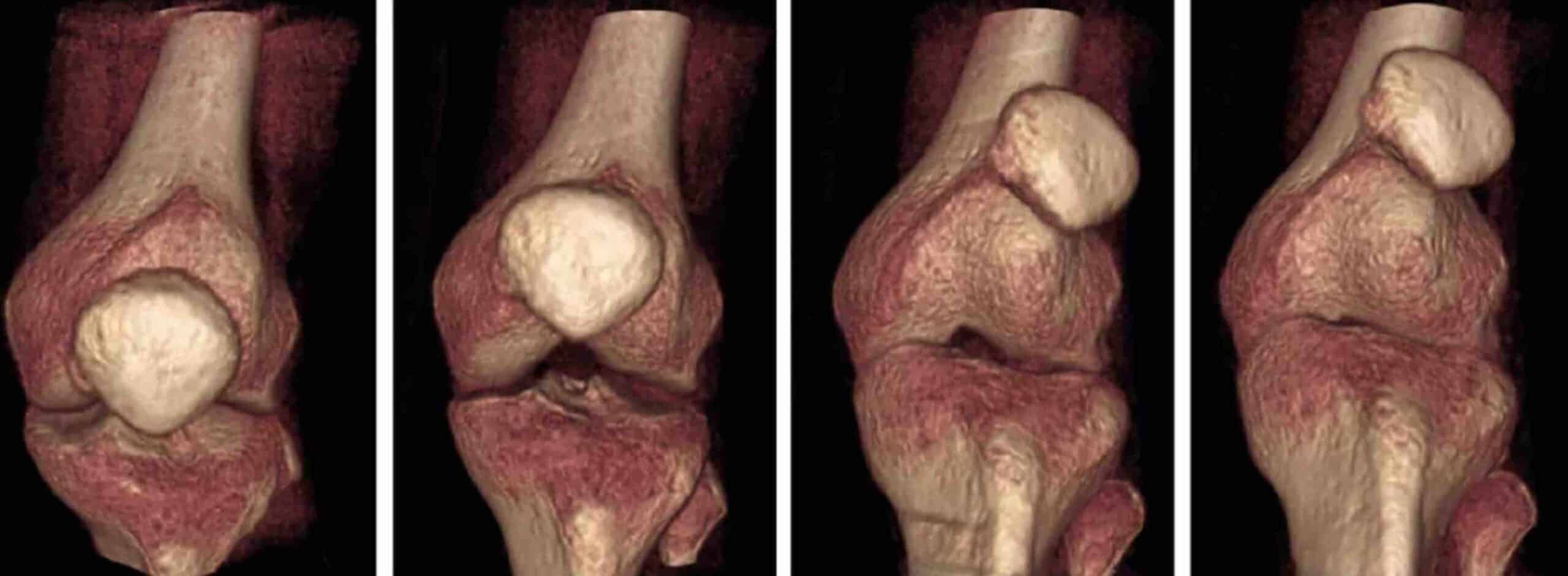 PATELA INSTABILIDADE