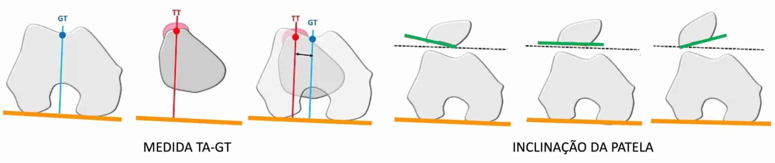 TA-GT E INCLINAÇÃO PATELAR